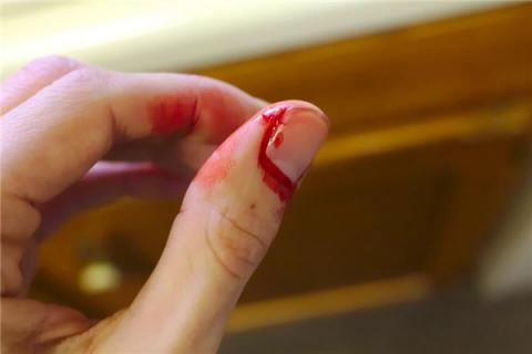 梦见病人的大拇指擦伤是什么预兆,梦见病人的大拇指擦伤是什么意思 梦见病人的大拇指擦伤是什么预兆,梦见病人的大拇指擦伤是什么意思